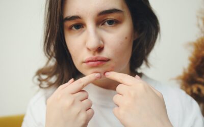 Apelidos para Pessoas com Espinhas